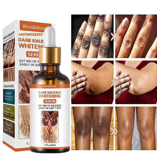 Dark Knuckle Whitening Serum In Kiffa Town in Mauritania Hand Elbow Knee Brightening Serum In Quriyat Town in Oman Call ☏ +2771 073 2372 Get Rid Of Vitiligo In Vaasa City In Finland, Scars And Stretch Marks In Polokwane City, Tattoo Removal In Saldanha Town And Vereeniging City In South Africa