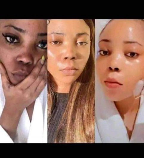 Kojic acid for skin lightening & prevent skin pigmentation +27 81 850 2816 Mahikeng, Lichtenburg, Coligny