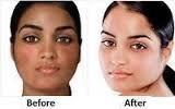 Skin lightening, bleaching & blemishes removal products +27 81 850 2816 Bloemfontein, Welkom