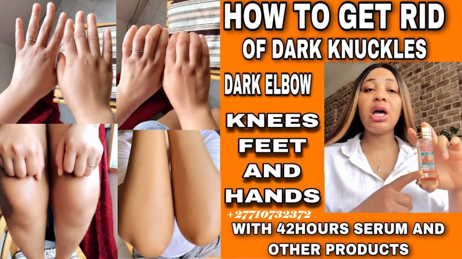 Dark Knuckle Whitening Serum In Kiffa Town in Mauritania Hand Elbow Knee Brightening Serum In Quriyat Town in Oman Call ☏ +2771 073 2372 Get Rid Of Vitiligo In Vaasa City In Finland, Scars And Stretch Marks In Polokwane City, Tattoo Removal In Saldanha Town And Vereeniging City In South Africa