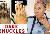 Dark Knuckle Whitening Serum In Kiffa Town in Mauritania Hand Elbow Knee Brightening Serum In Quriyat Town in Oman Call ☏ +2771 073 2372 Get Rid Of Vitiligo In Vaasa City In Finland, Scars And Stretch Marks In Polokwane City, Tattoo Removal In Saldanha Town And Vereeniging City In South Africa