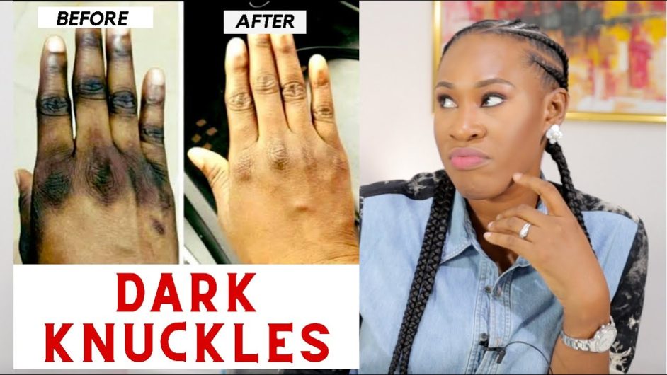 Dark Knuckle Whitening Serum In Kiffa Town in Mauritania Hand Elbow Knee Brightening Serum In Quriyat Town in Oman Call ☏ +2771 073 2372 Get Rid Of Vitiligo In Vaasa City In Finland, Scars And Stretch Marks In Polokwane City, Tattoo Removal In Saldanha Town And Vereeniging City In South Africa